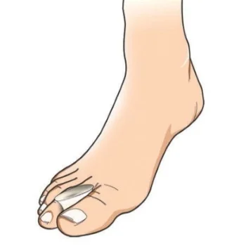 Fortuna separator za nožni palac FT-1257-1